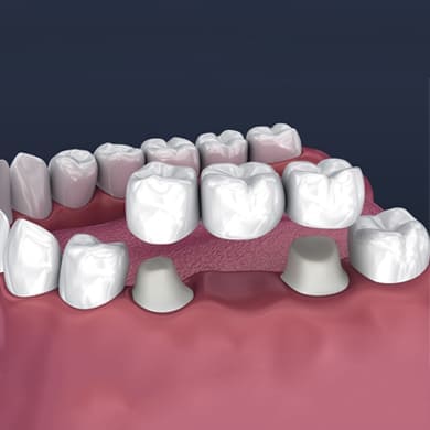 Dental Bridges