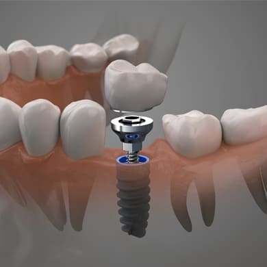 Dental Implants