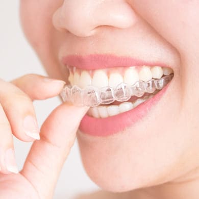 Clear Aligners