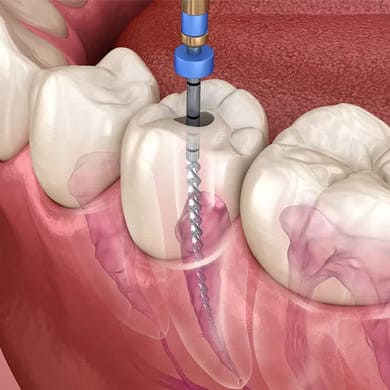 root-canal-treatment