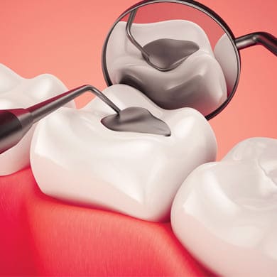 teeth-fillings