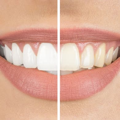 teeth-whitening
